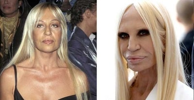 A picture of Donatella Versace before (left) and after (right).